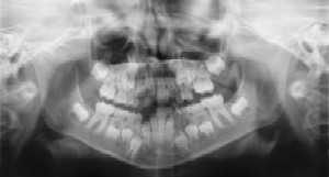 Dental Radiographs (X-Rays) - Pediatric Dentist in Phoenix, AZ