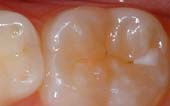 Sealant-Before - Pediatric Dentist in Phoenix, AZ